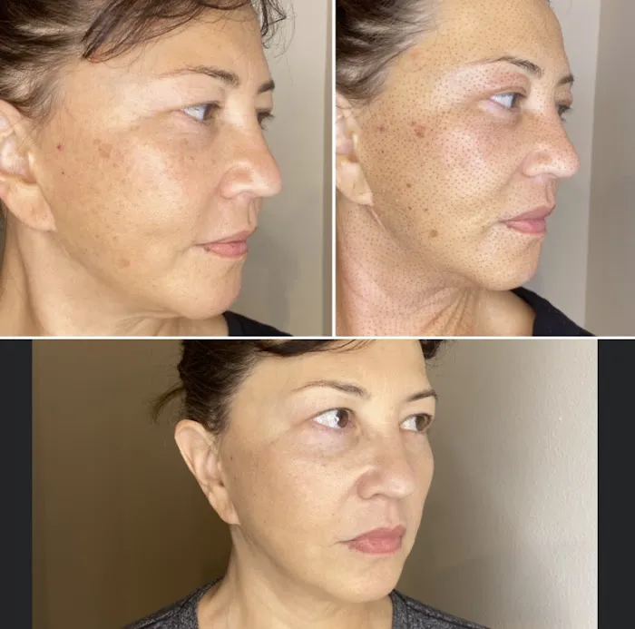 Eternal Youth Plasma Skin Tightening Therapy Picture 9