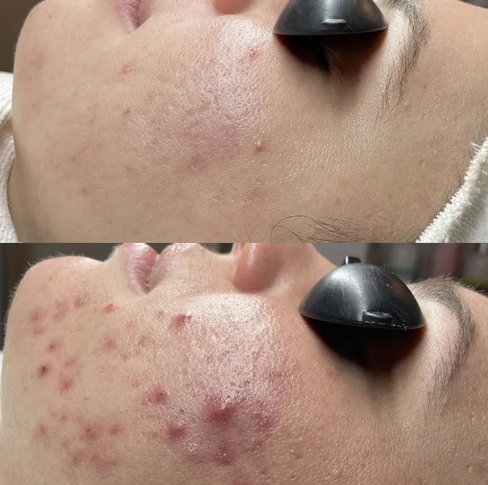 Acne Specialists of Nashville Picture 1