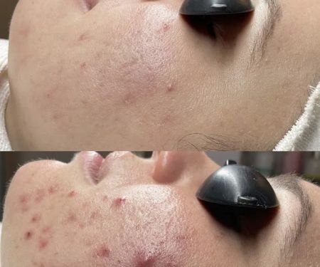 Acne Specialists of Nashville