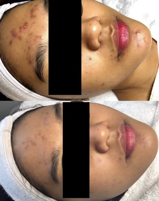 Acne Specialists of Nashville Picture 5