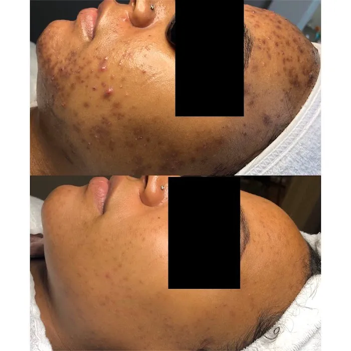 Acne Specialists of Nashville Picture 6