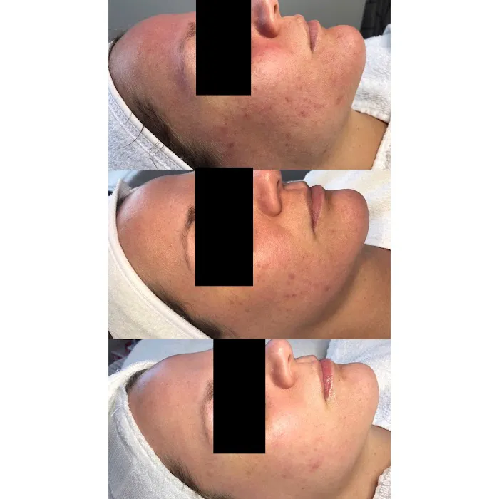 Acne Specialists of Nashville Picture 8