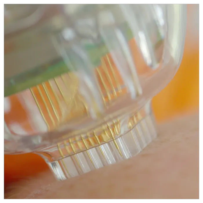 James Mott, NCEA, Microneedling Picture 2