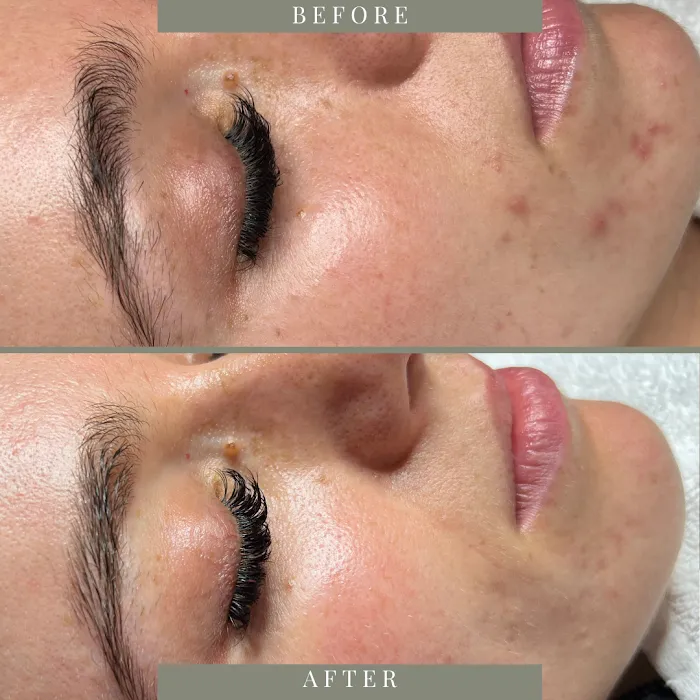 Bare Beauty Aesthetics | Chandler Acne Specialist + Brow Design Picture 3