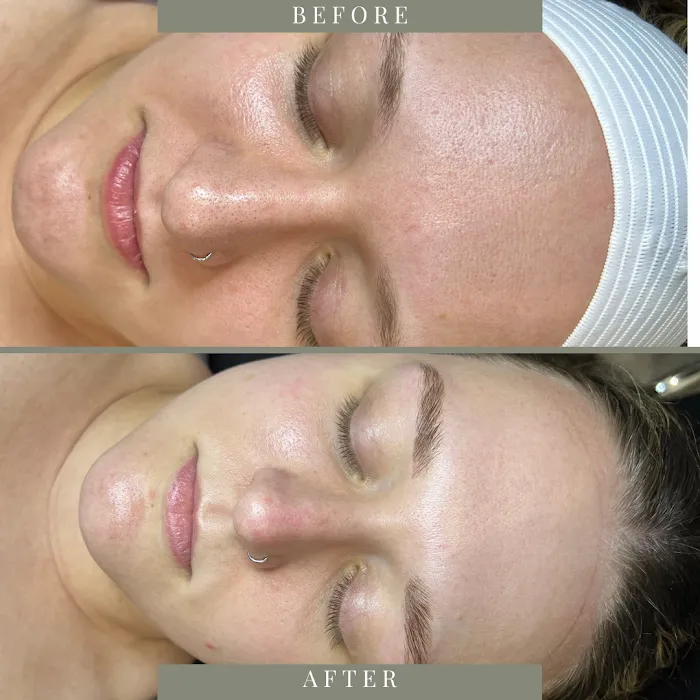 Bare Beauty Aesthetics | Chandler Acne Specialist + Brow Design Picture 7