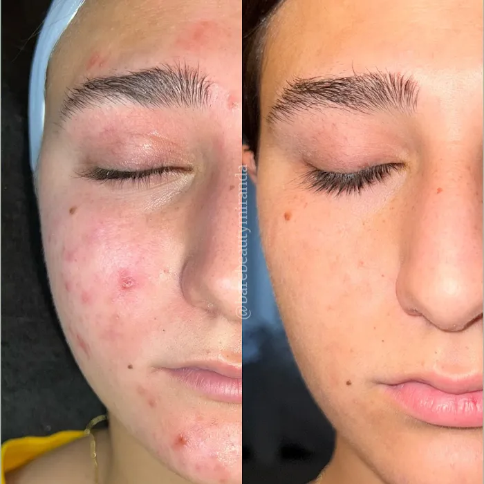 Bare Beauty Aesthetics | Chandler Acne Specialist + Brow Design Picture 8