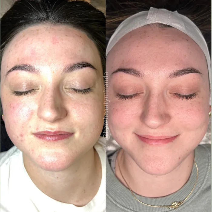 Bare Beauty Aesthetics | Chandler Acne Specialist + Brow Design Picture 10