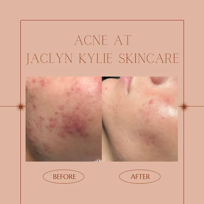 Jaclyn Kylie Skincare Picture 10