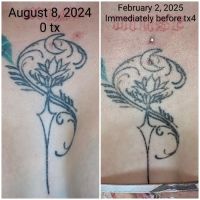 Time Warp Esthetics and Laser ico