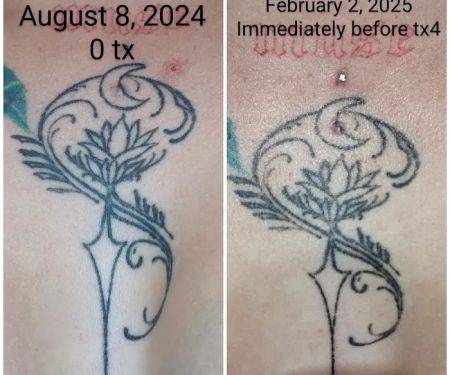 Time Warp Esthetics and Laser