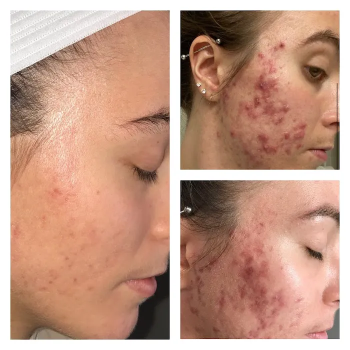 Acne Advisors Picture 2