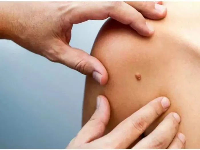 SWIFT Wart Removal Scottsdale Picture 5