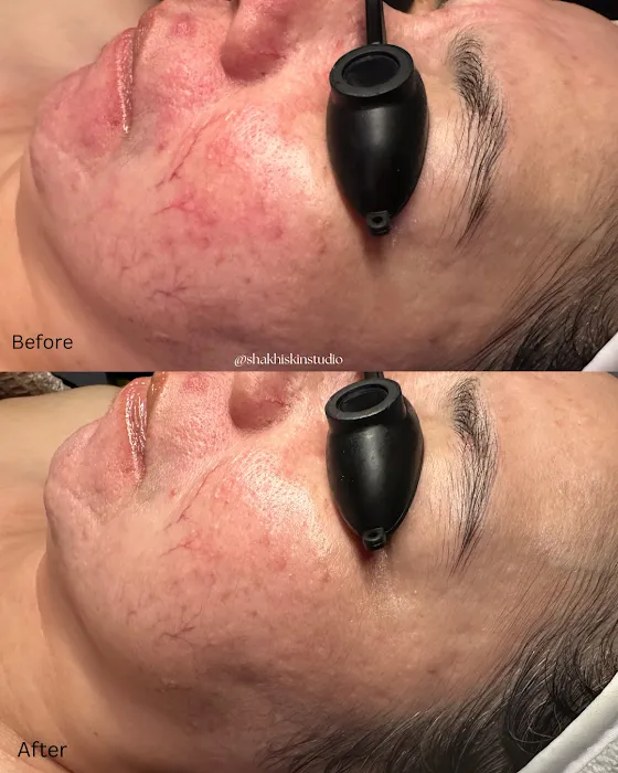 SHAKHI SKIN STUDIO - Santa Clara Facials & Brazilian Waxing Picture 8