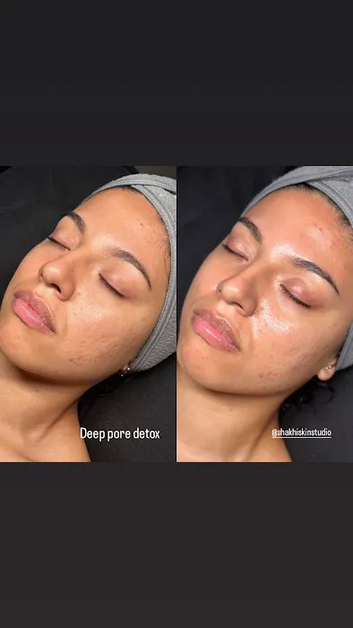 SHAKHI SKIN STUDIO - Santa Clara Facials & Brazilian Waxing Picture 6