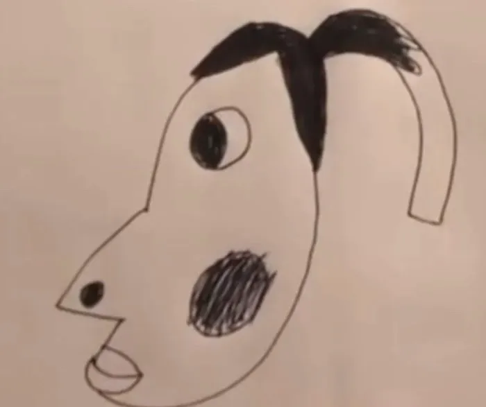 Hyperpigmentation San Jose Picture 1