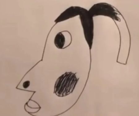 Hyperpigmentation San Jose