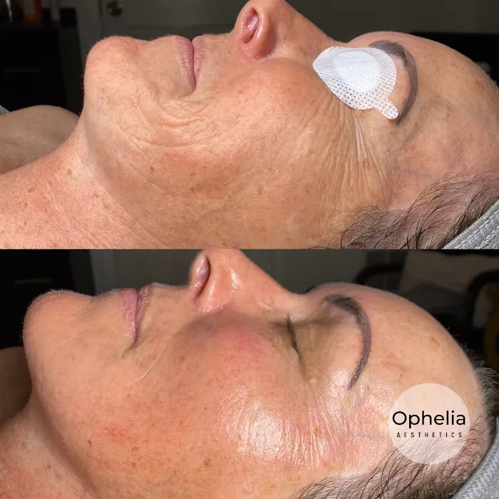 Ophelia Aesthetics Picture 8