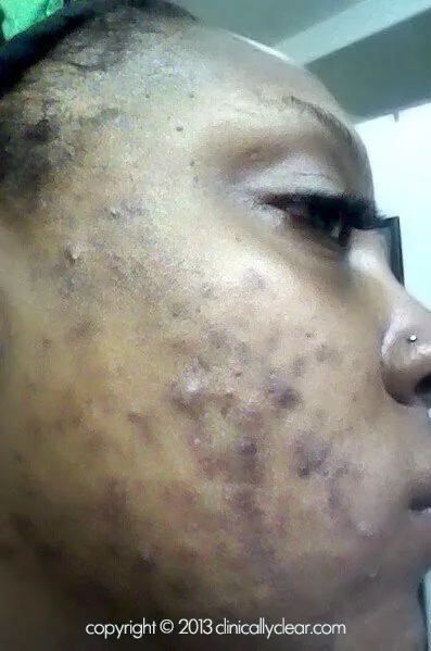 Clinically Clear® Picture 3