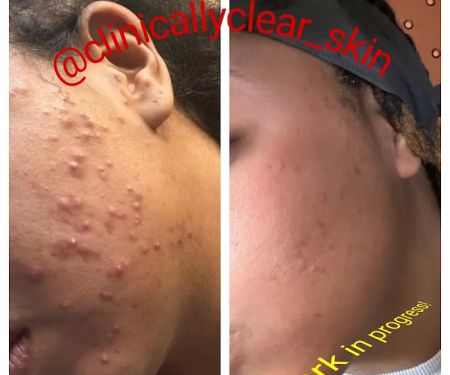 Clinically Clearu00ae