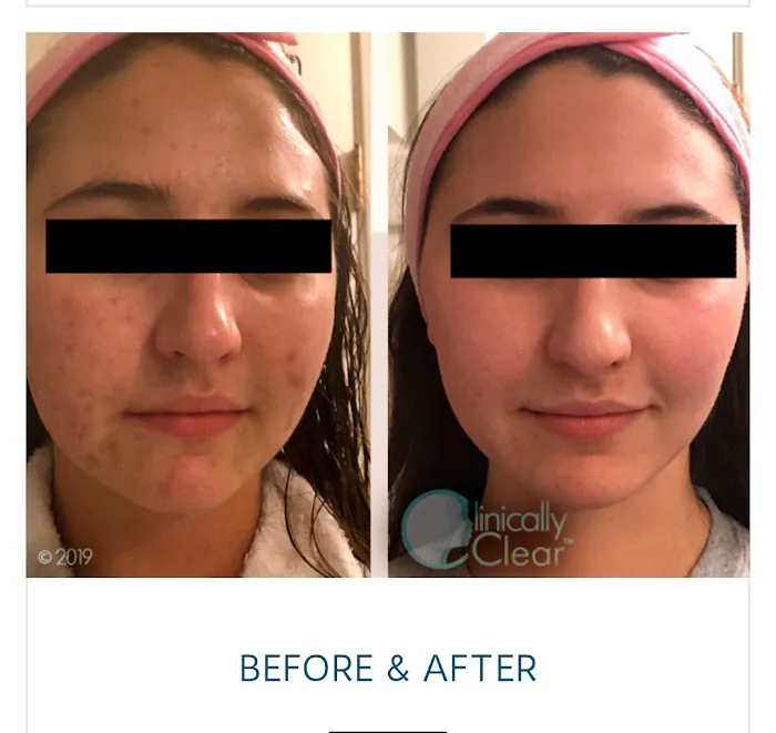 Clinically Clear® Picture 4