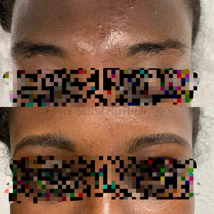 GLOWDEGA | Oakland Acne Experts & Brazilian Sugaring Picture 9