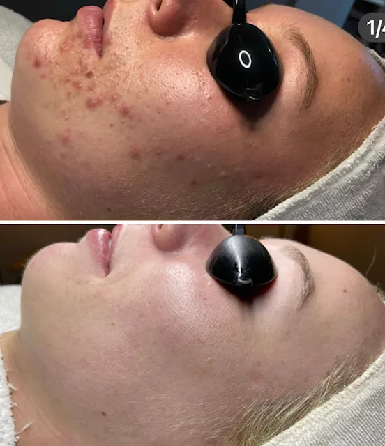 Acne Specialists of Oakland Picture 2