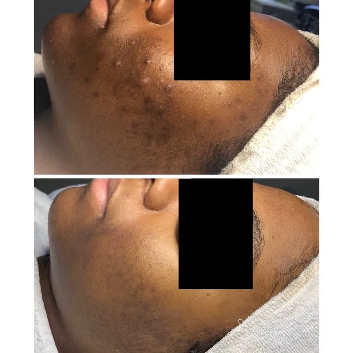 Acne Specialists of Oakland Picture 5