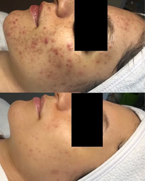 Acne Specialists of Oakland Picture 4