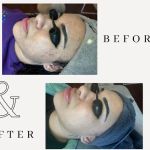 Amy Earnest Acne Specialist