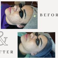 Amy Earnest Acne Specialist ico