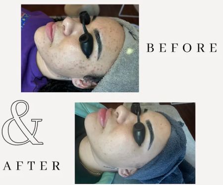 Amy Earnest Acne Specialist