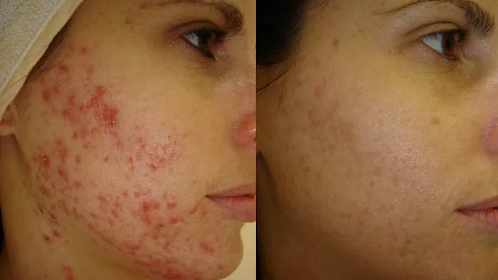 Pure Skin Electrolysis Picture 1