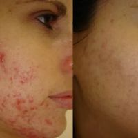 Pure Skin Electrolysis ico