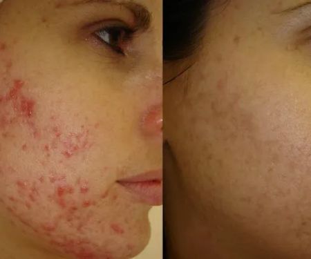 Pure Skin Electrolysis
