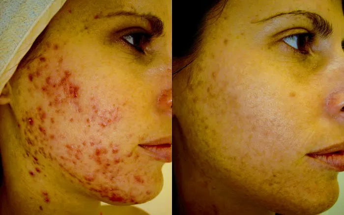 Pure Skin Electrolysis Picture 2