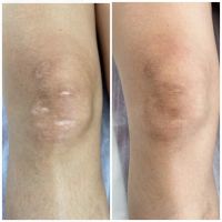 Invisible Ink Skin Solutions ico