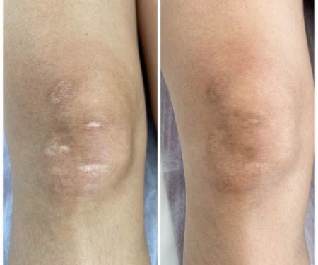 Invisible Ink Skin Solutions