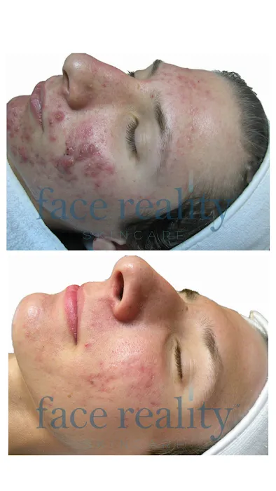 Face Reality Acne Clinic Picture 6