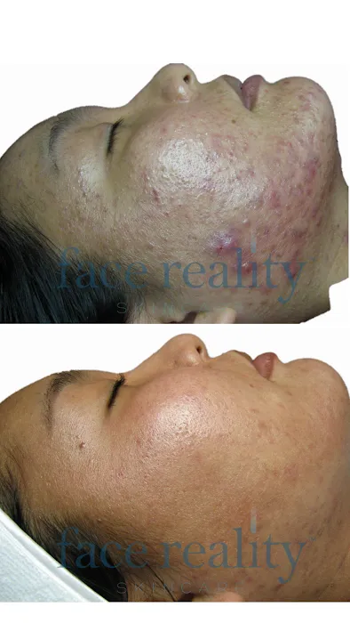 Face Reality Acne Clinic Picture 8