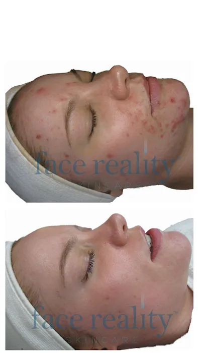 Face Reality Acne Clinic Picture 9