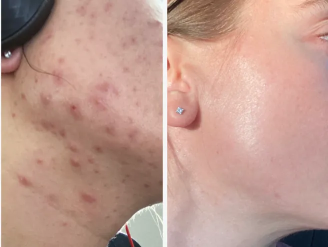 Brentwood Acne Clinic Picture 2