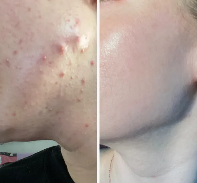 Brentwood Acne Clinic Picture 1