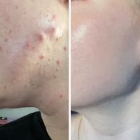 Brentwood Acne Clinic ico