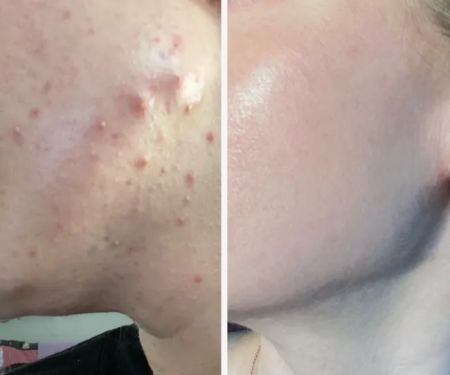 Brentwood Acne Clinic