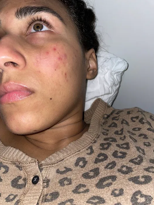 Carson Skin Rejuvenation Picture 9