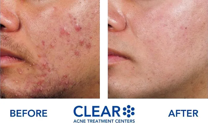 CLEAR Acne Treatment Centers Picture 7