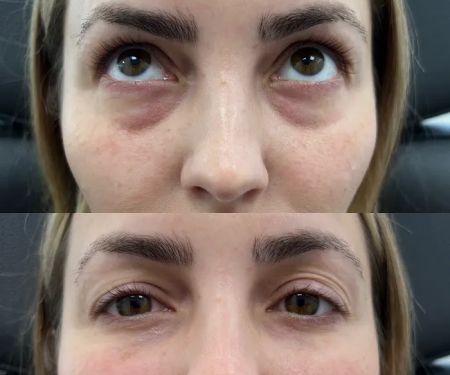 Caleb Martin, Austin Nurse Injector - Advanced Botox & Filler