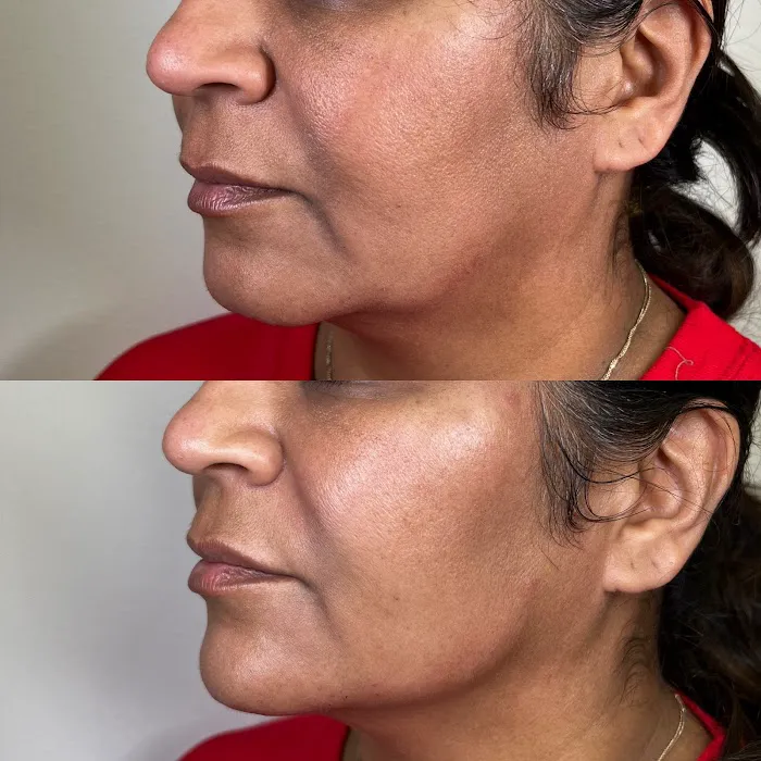 Caleb Martin, Austin Nurse Injector - Advanced Botox & Filler Picture 9