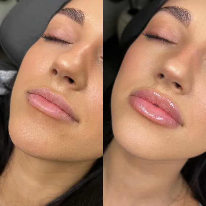 Caleb Martin, Austin Nurse Injector - Advanced Botox & Filler Picture 4