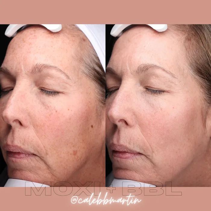 Caleb Martin, Austin Nurse Injector - Advanced Botox & Filler Picture 10
